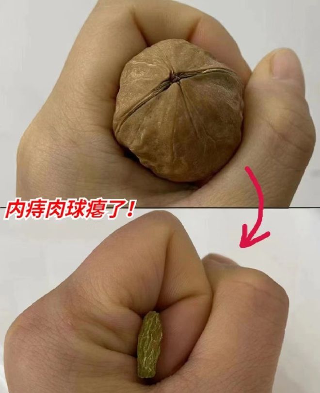 痔疮便血、肉球肿痛？只要做好这3步在家就能轻松治愈不复发！(图5)