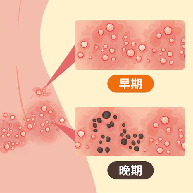 kaiyun开云网站【名医名科】带状疱疹疼痛难忍？您可以相信