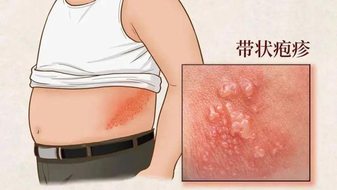 kaiyun开云网站【名医名科】带状疱疹疼痛难忍？您可以相信针灸治疗！(图2)