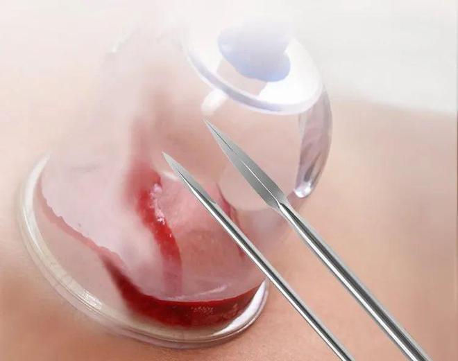 kaiyun开云网站【名医名科】带状疱疹疼痛难忍？您可以相信针灸治疗！(图6)