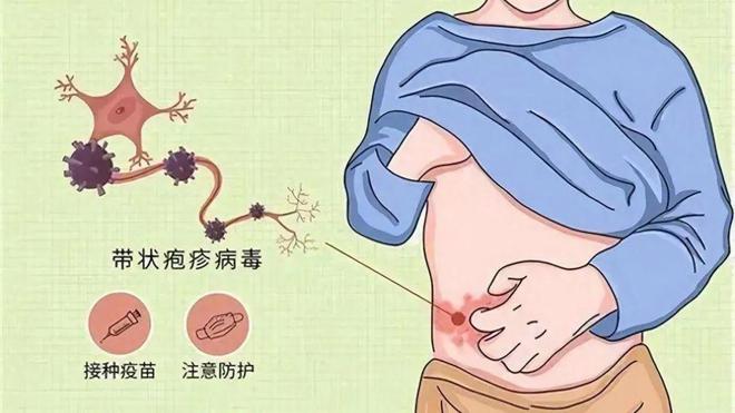 kaiyun开云网站【名医名科】带状疱疹疼痛难忍？您可以相信针灸治疗！(图7)