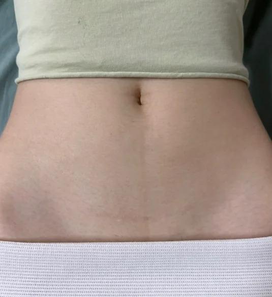 疤痕不用激光也能消！学会这一招疤痕快速解决不反复！(图3)