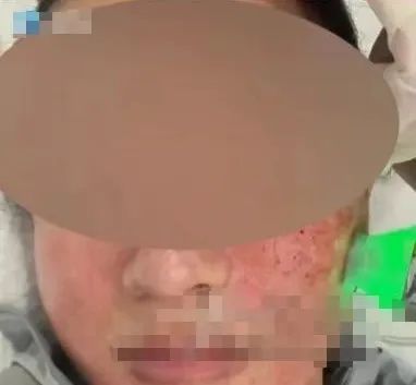 医美界大火的“黄金微针”到底什么来头？ 看完你还敢做吗