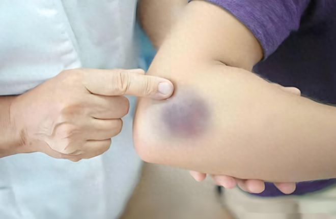 身上为什么总是青一块、紫一块的？医生直言：多半和8个原因有关