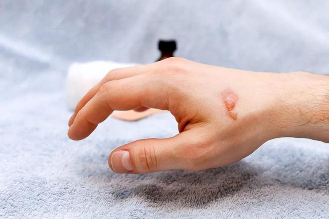 身上为什么总是青一块、紫一块的？医生直言：多半和8个原因有关(图7)