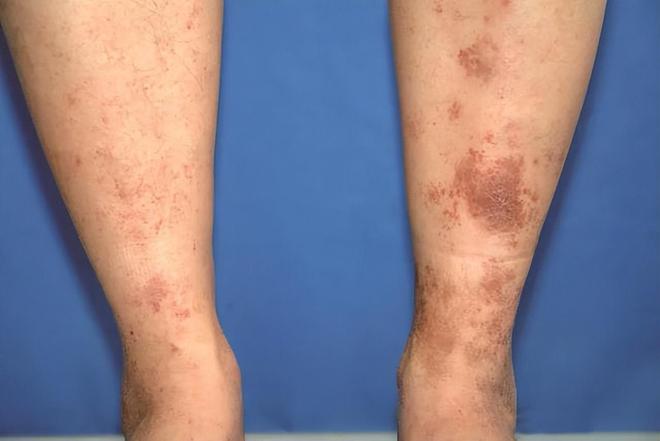 身上为什么总是青一块、紫一块的？医生直言：多半和8个原因有关(图8)